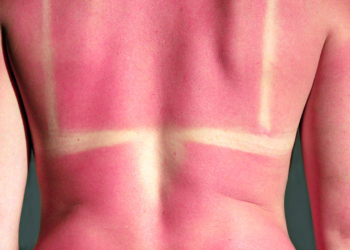 The Truth About 'Life-Changing Sunburns,' According to a Dermatologist