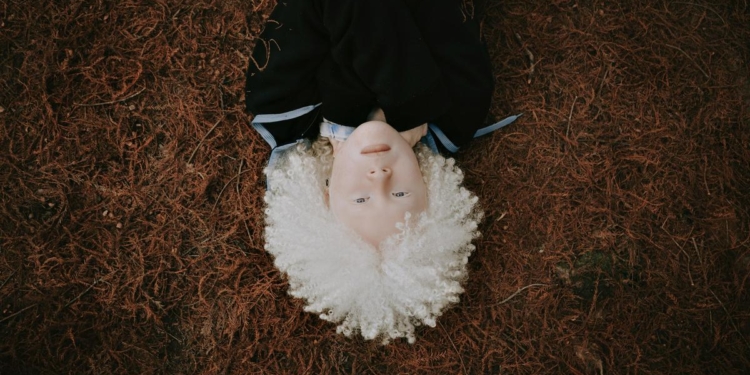 Understanding albinism