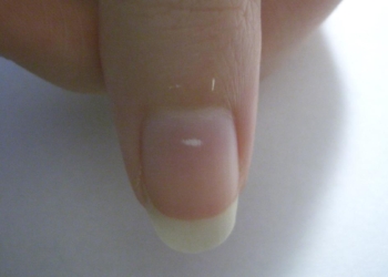 What changes in your nails may reveal about nutrition, trauma and chronic disease