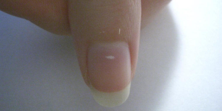 What changes in your nails may reveal about nutrition, trauma and chronic disease